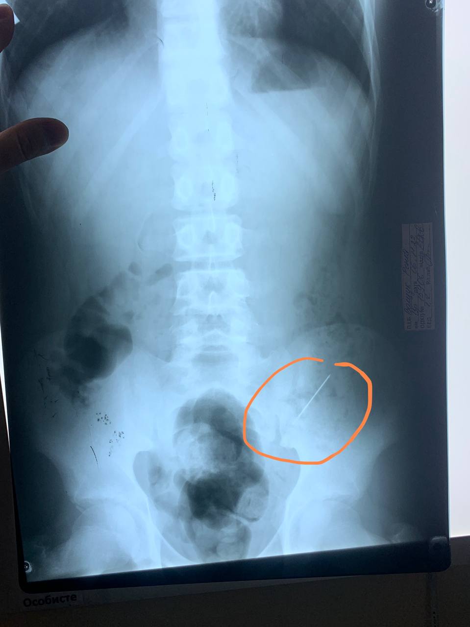 рентген мальчика